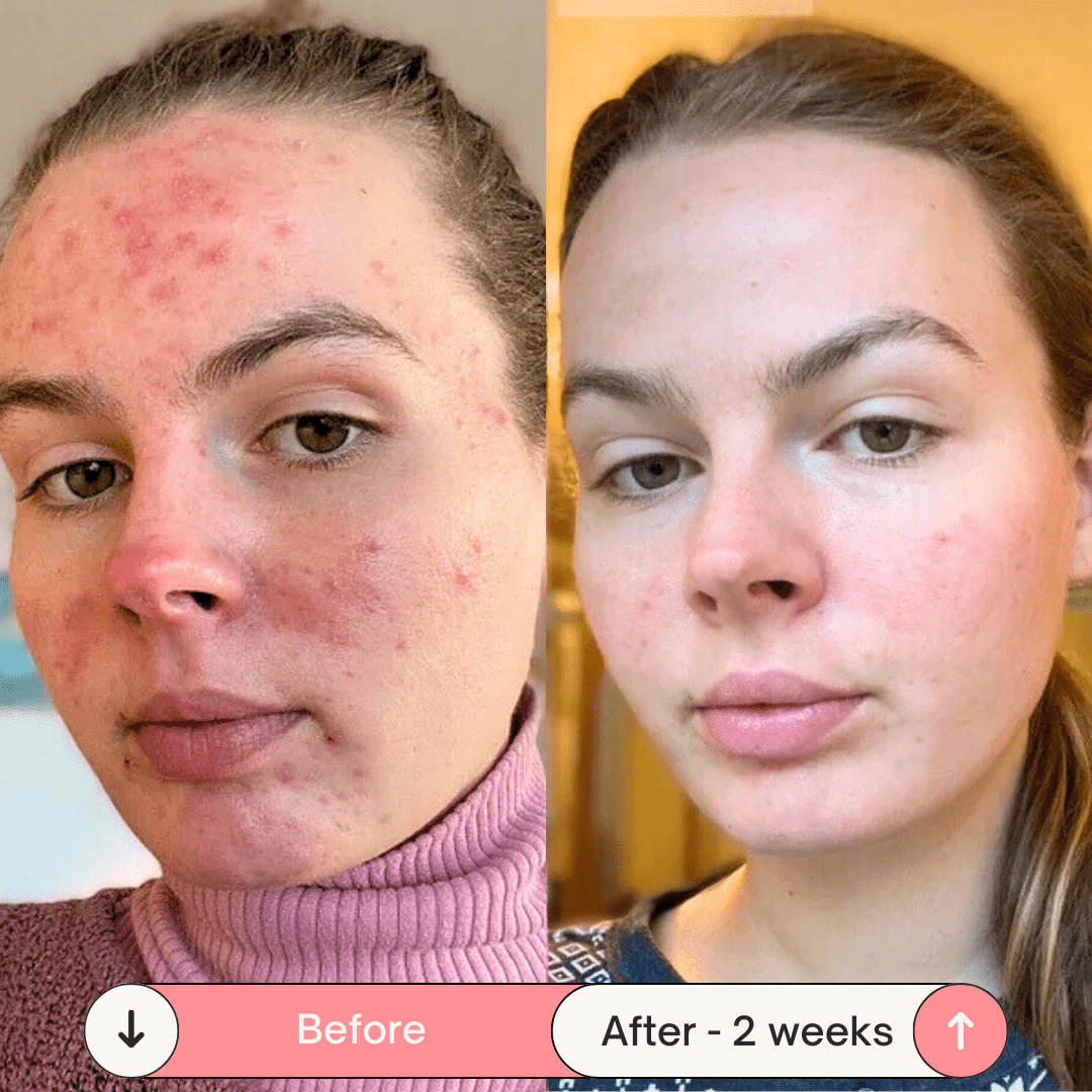 DermaPulse 2.0 – Skin Rejuvenation Wand - ZYRA