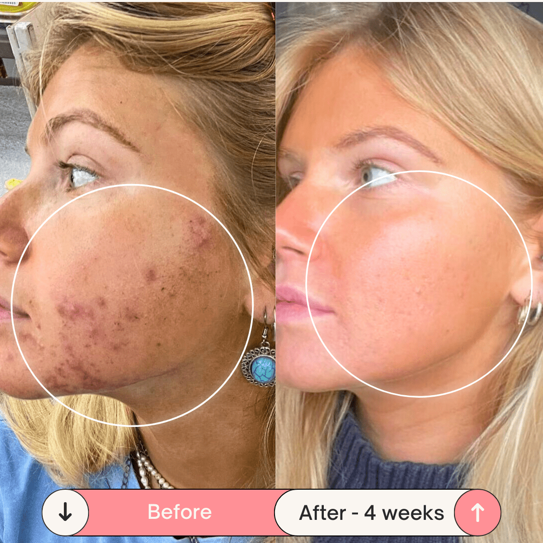 DermaPulse 2.0 – Skin Rejuvenation Wand - ZYRA