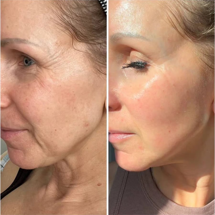 The Vita - A Retinal Shot Tightening Booster - ZYRA