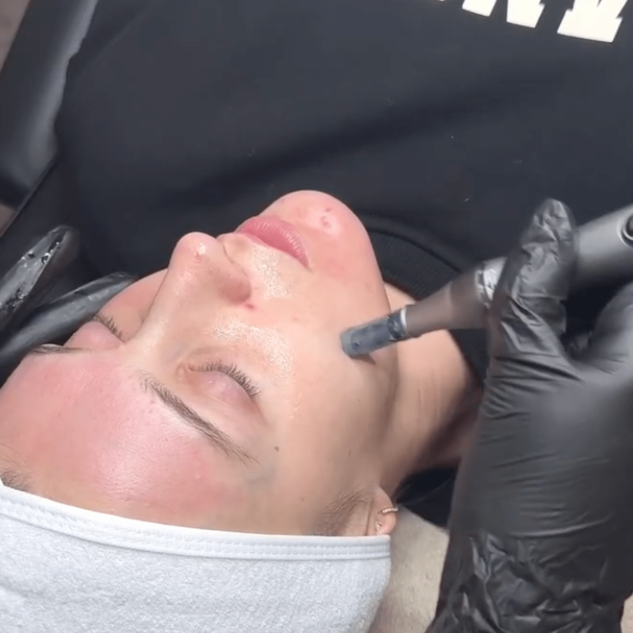 ZYRA Rejuvenating Pen - ZYRA