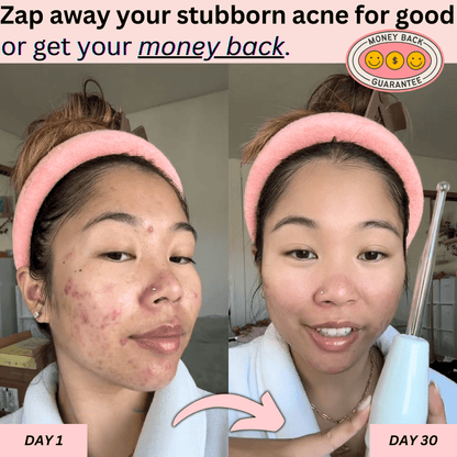 DermaPulse 2.0 – Skin Rejuvenation Wand - ZYRA