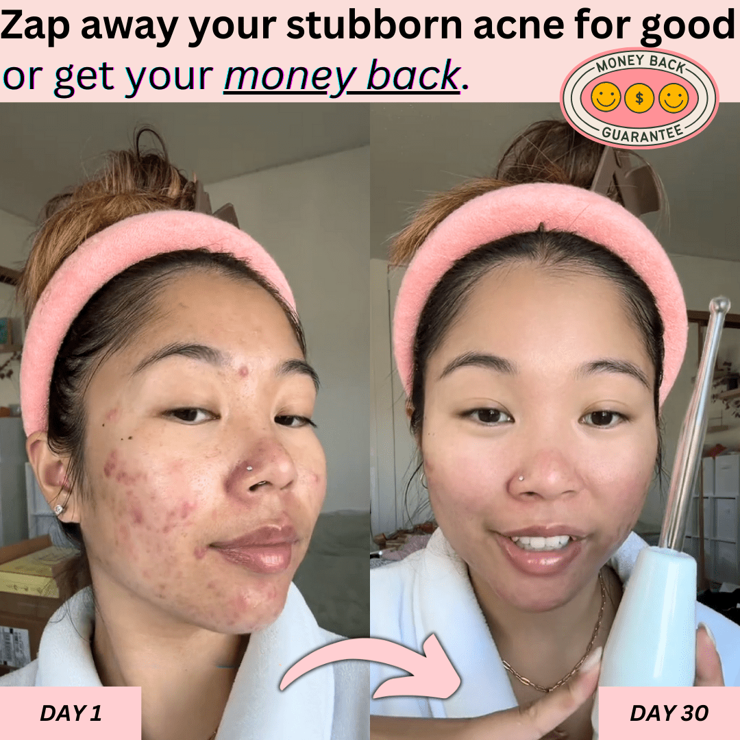 DermaPulse 2.0 – Skin Rejuvenation Wand - ZYRA