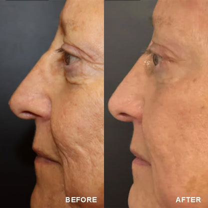 The Vita - A Retinal Shot Tightening Booster - ZYRA