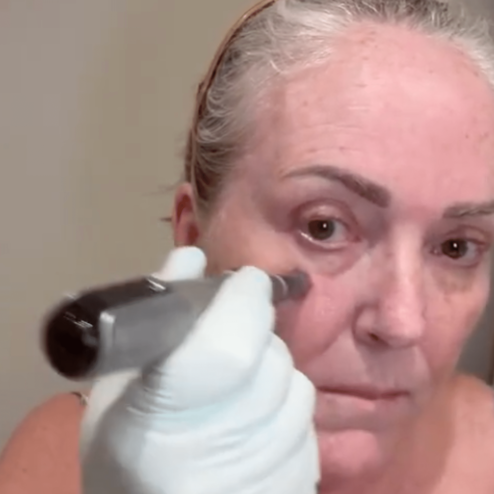 ZYRA Rejuvenating Pen - ZYRA