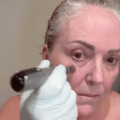 ZYRA Rejuvenating Pen - ZYRA